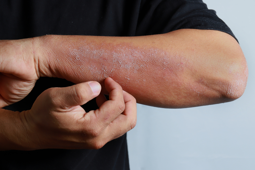 Accutane Apotheke Online