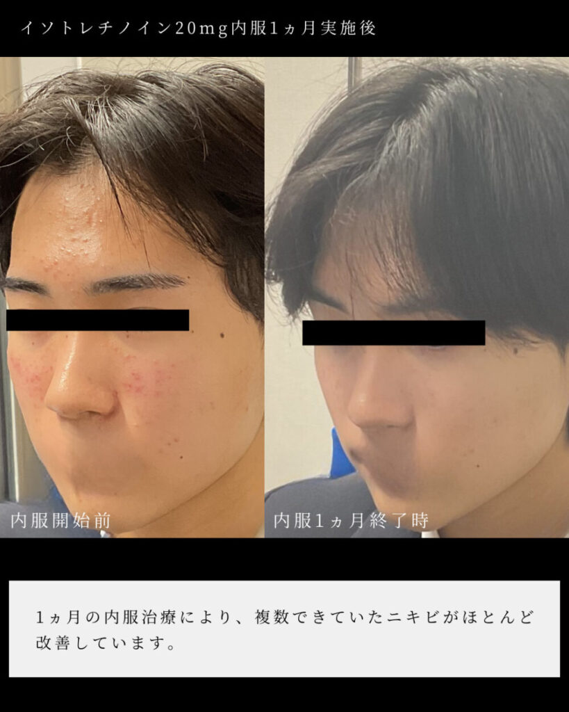 Billigste isotretinoin