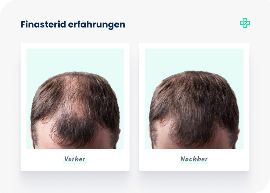 finasteride generikum