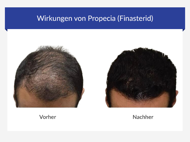 Propecia online bestellen schweiz