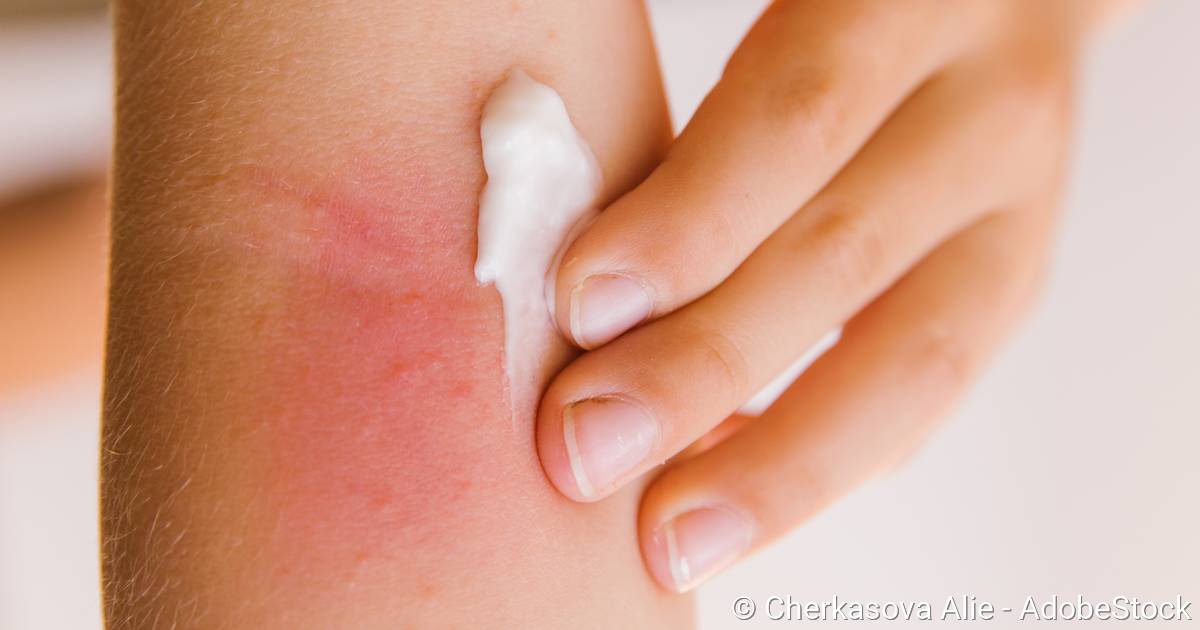 Prednisolon 4 Tabletten Auf Einmal