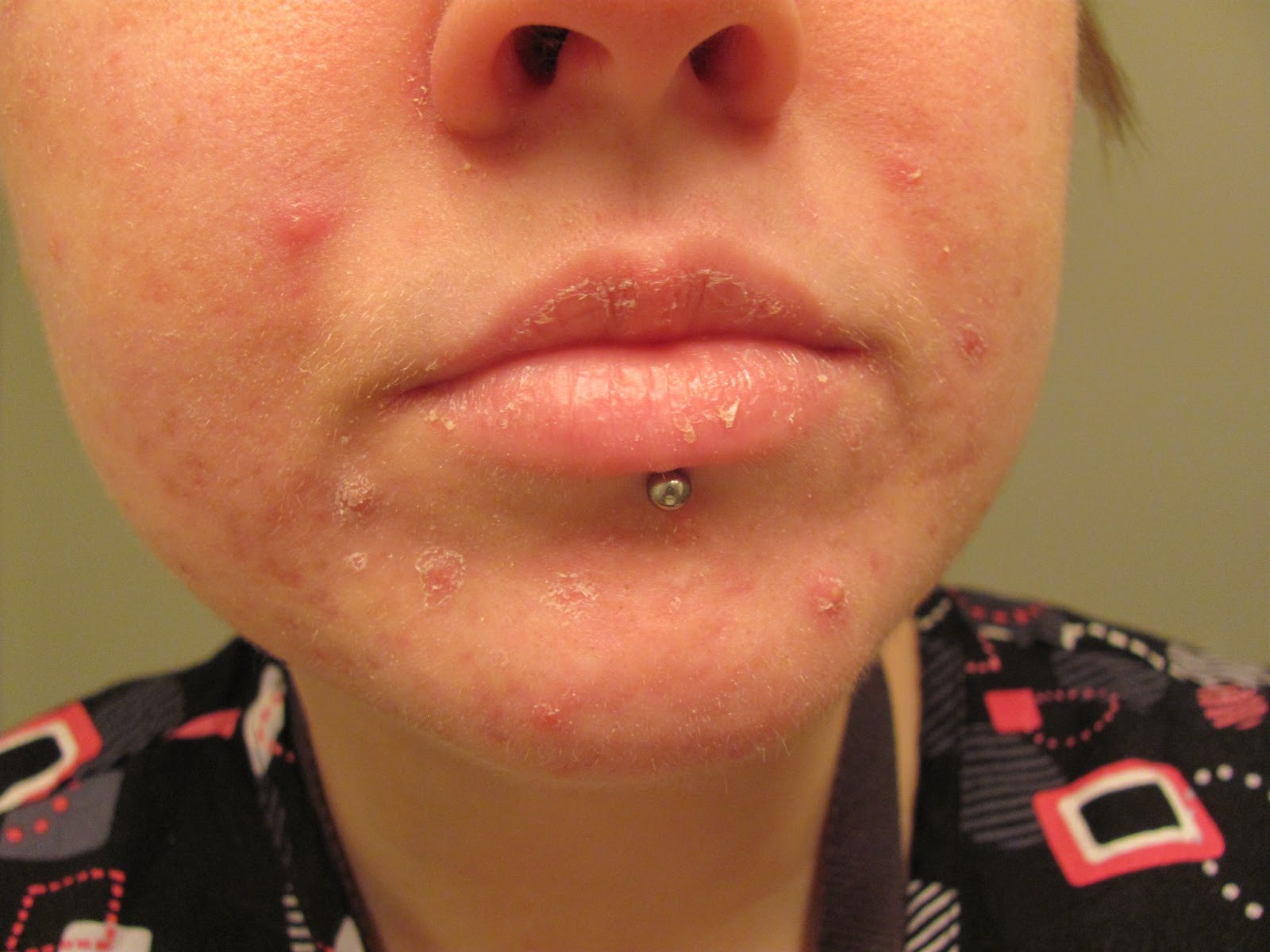 Isotretinoin in deutschland