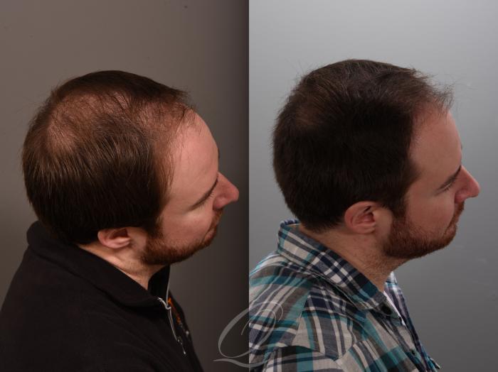 kosten van finasteride