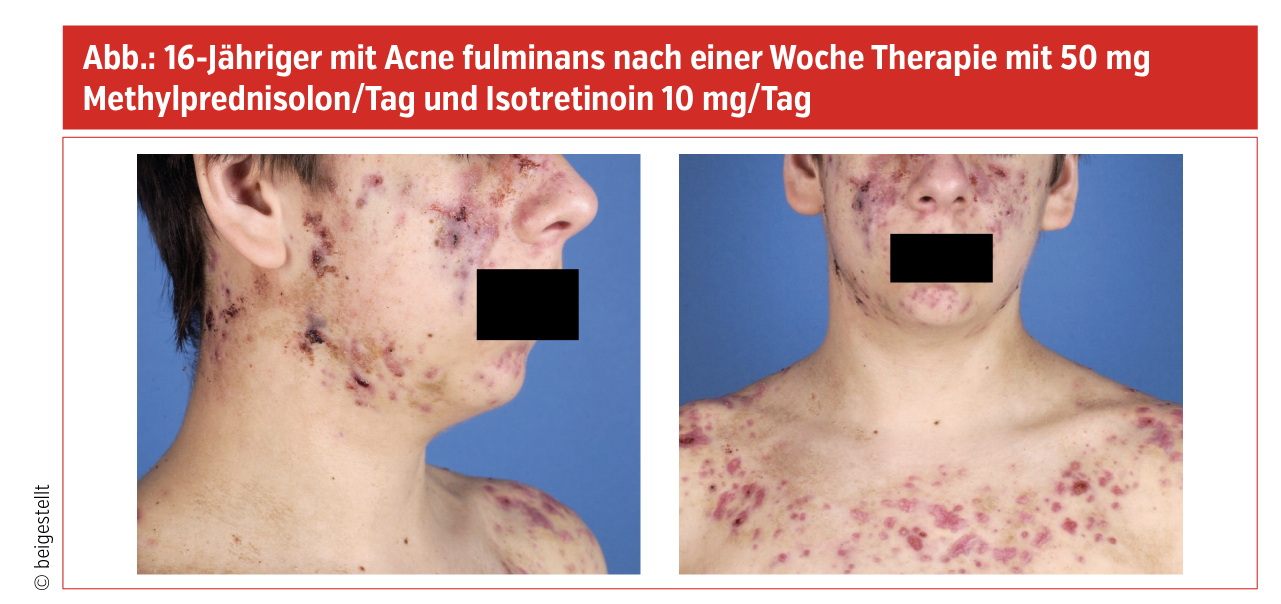 Isotretinoin tabletten medikamente