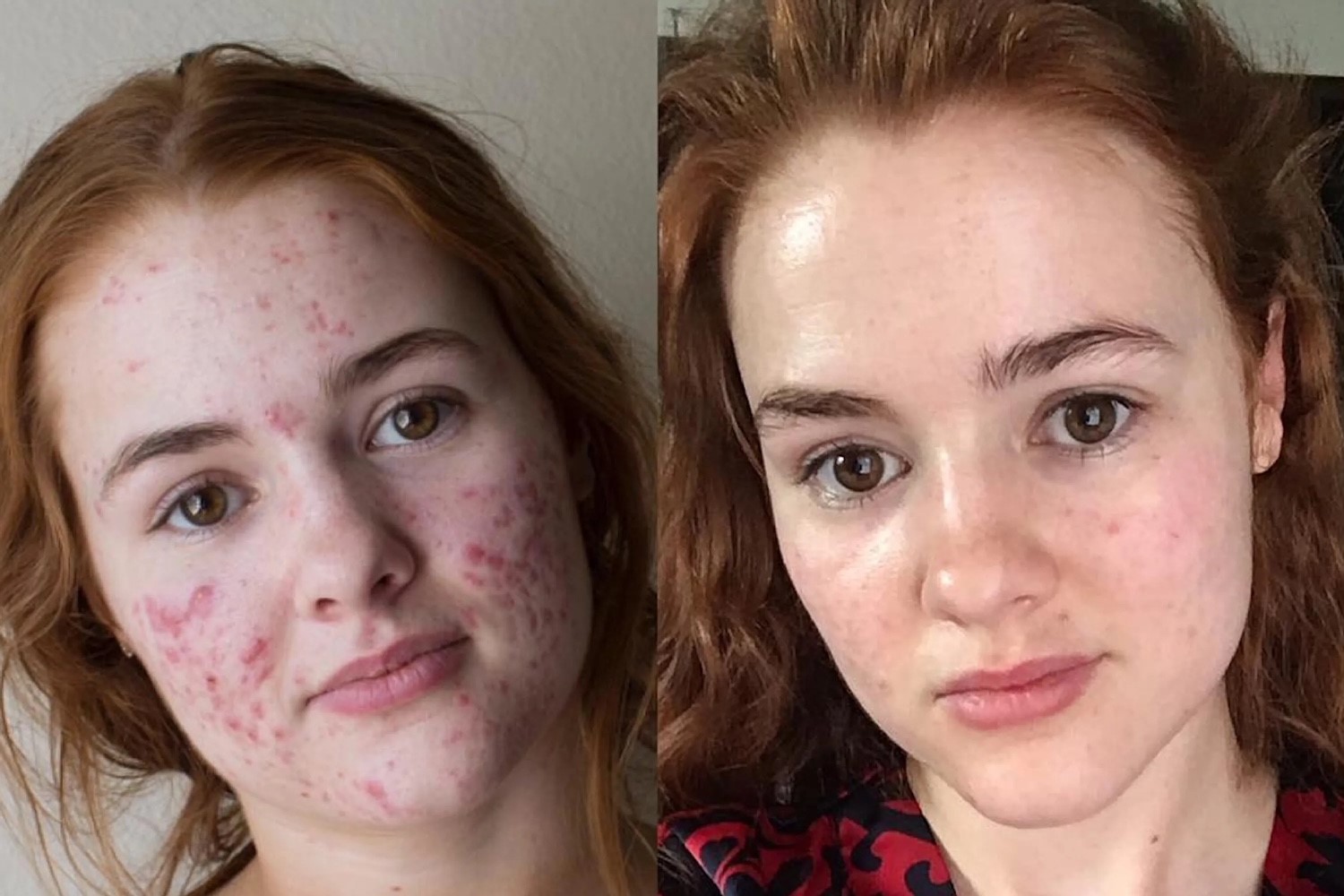 billigste isotretinoin