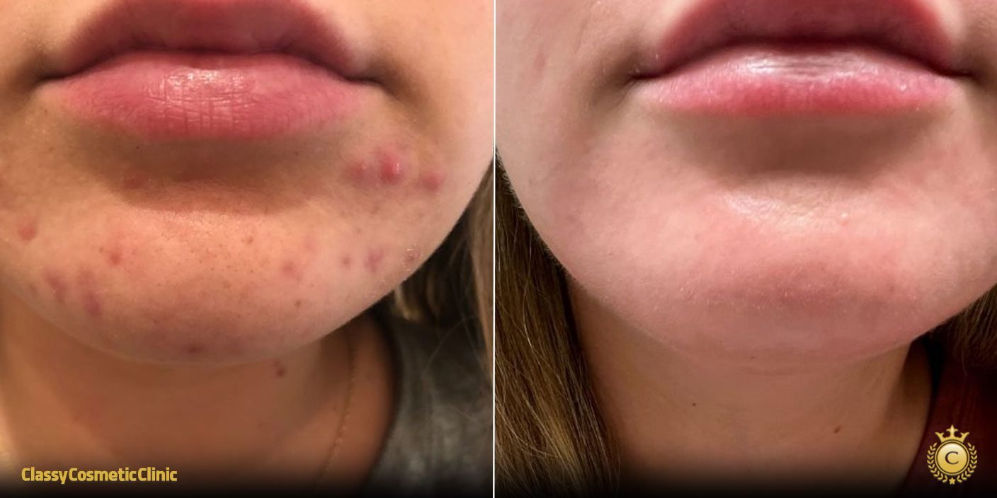 Preis Für Accutane