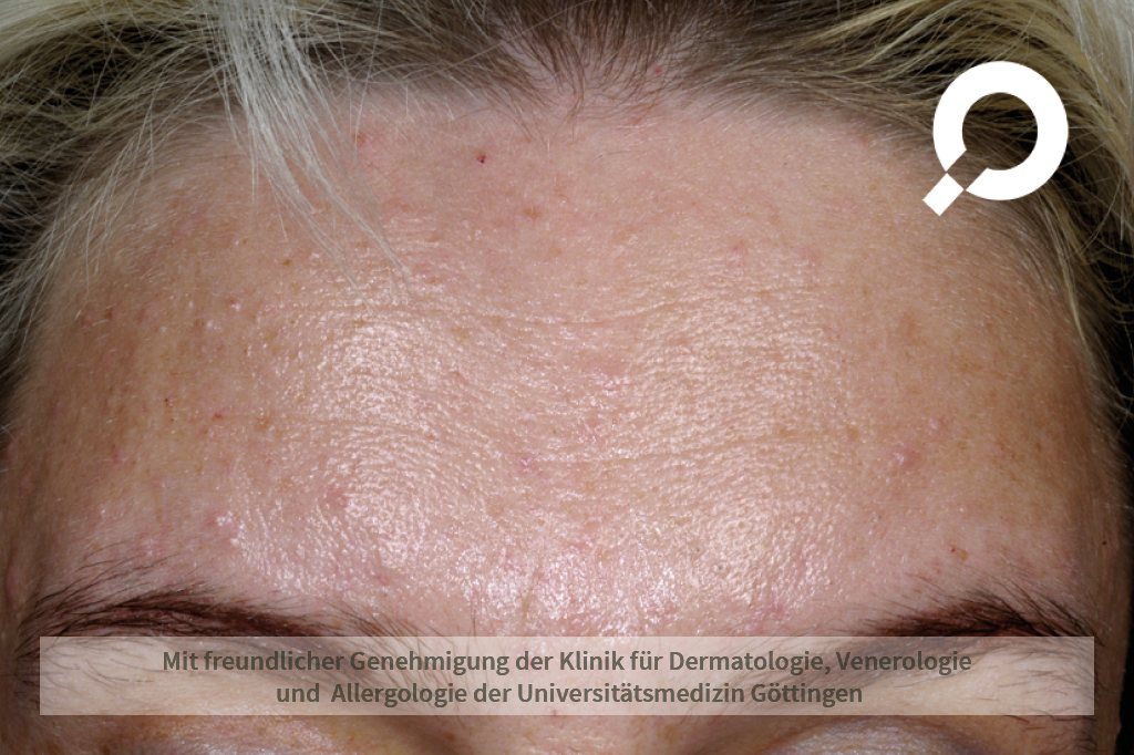 Isotretinoin creme oder tabletten