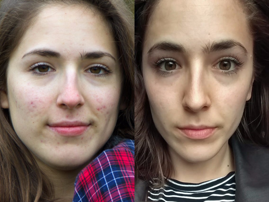Roaccutane In Deutschland