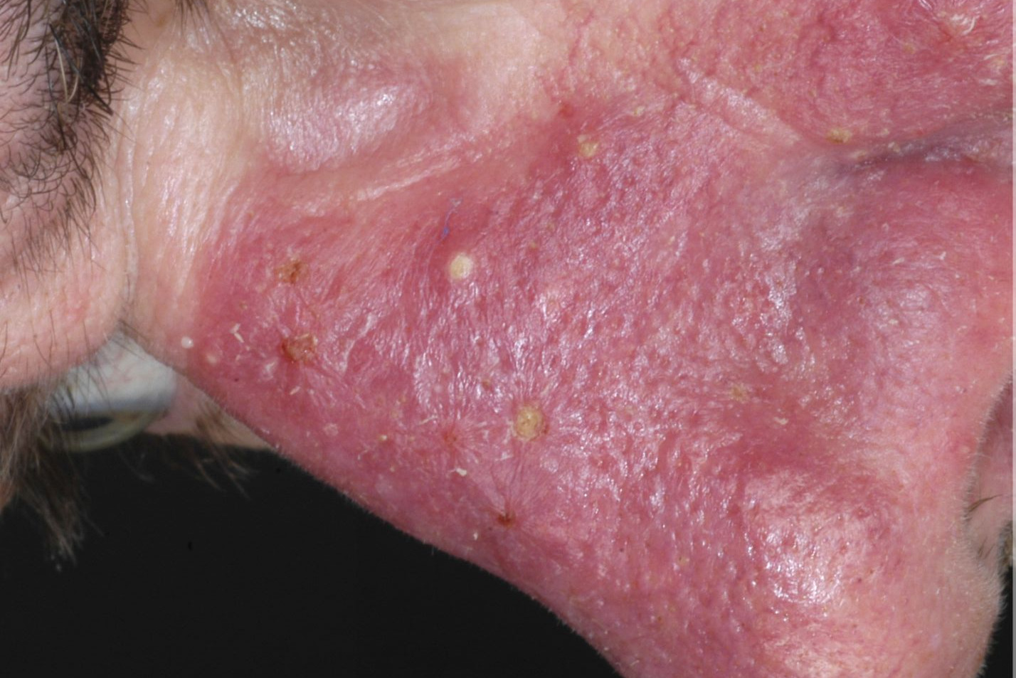 Accutane Deutschland