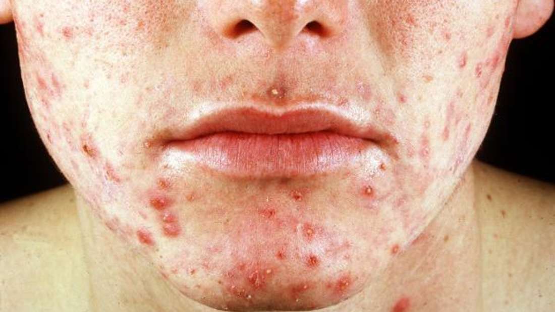 Isotretinoin Mit Pille
