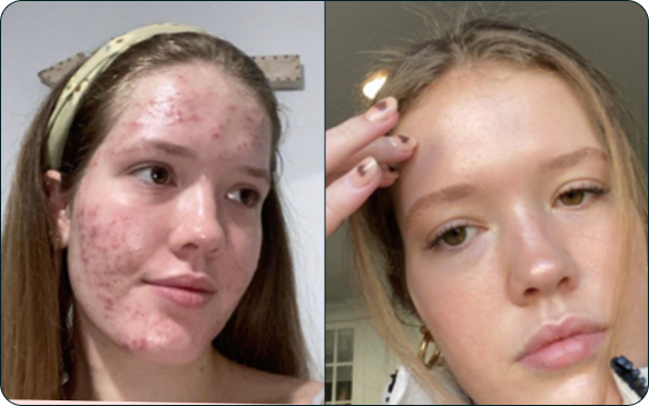 accutane online