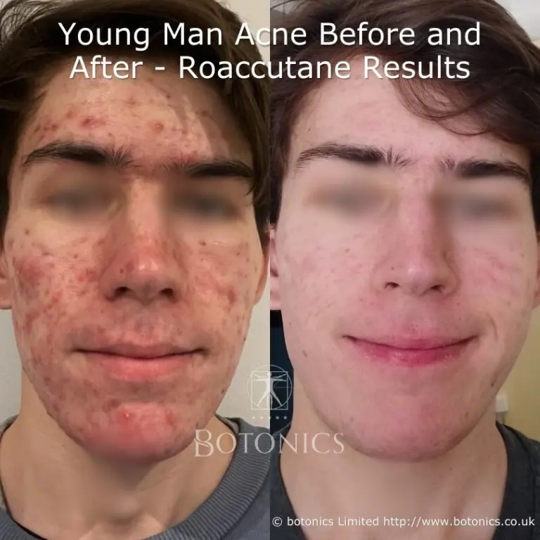 Billiges accutane
