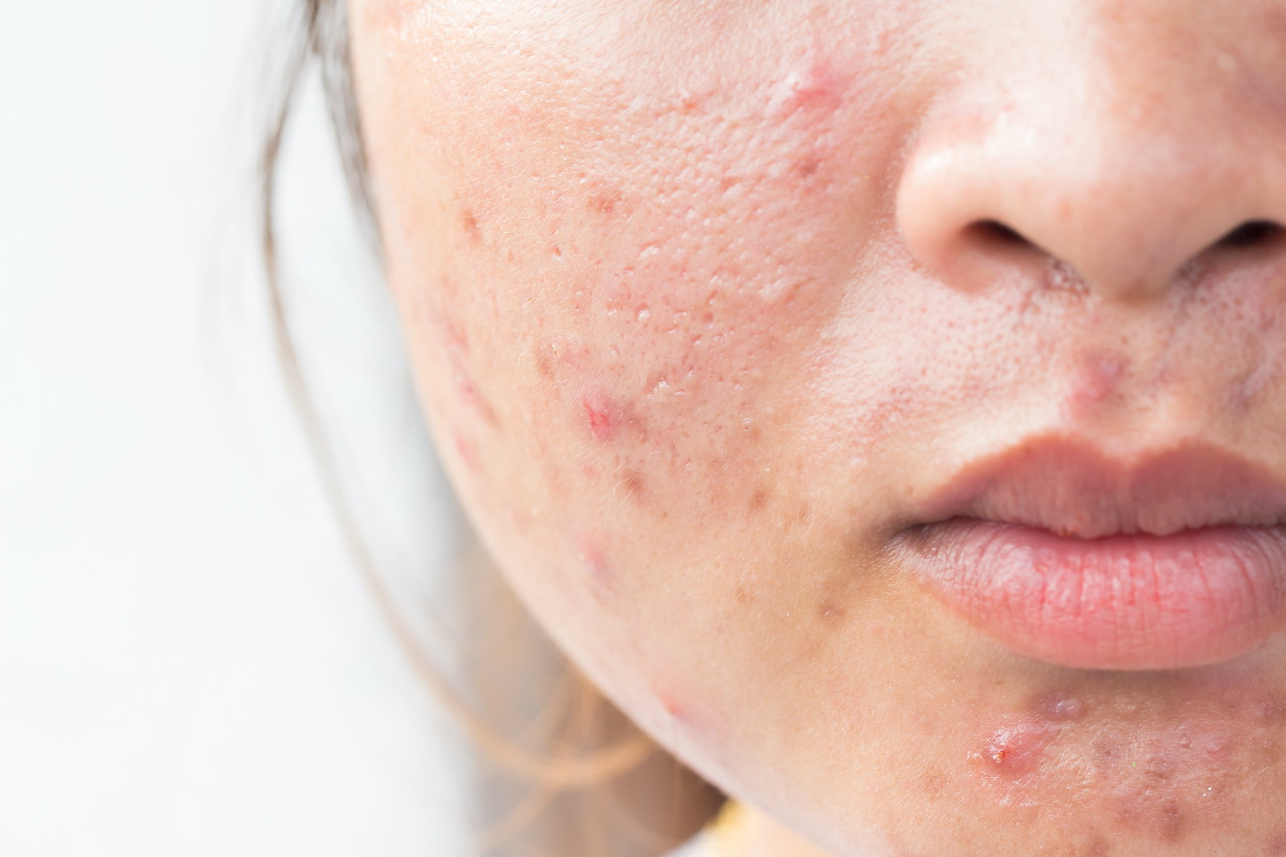 Roaccutane Generika