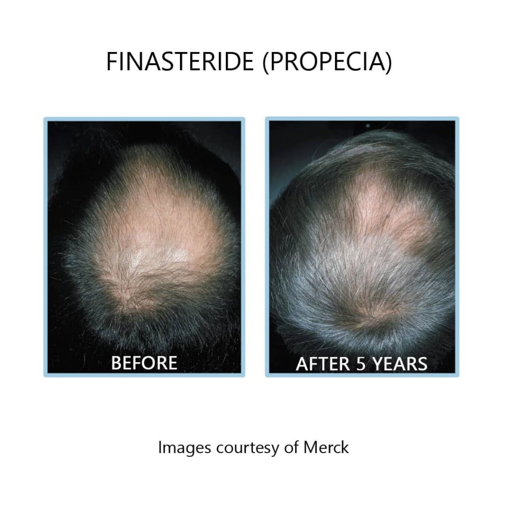 Generisches finasteride