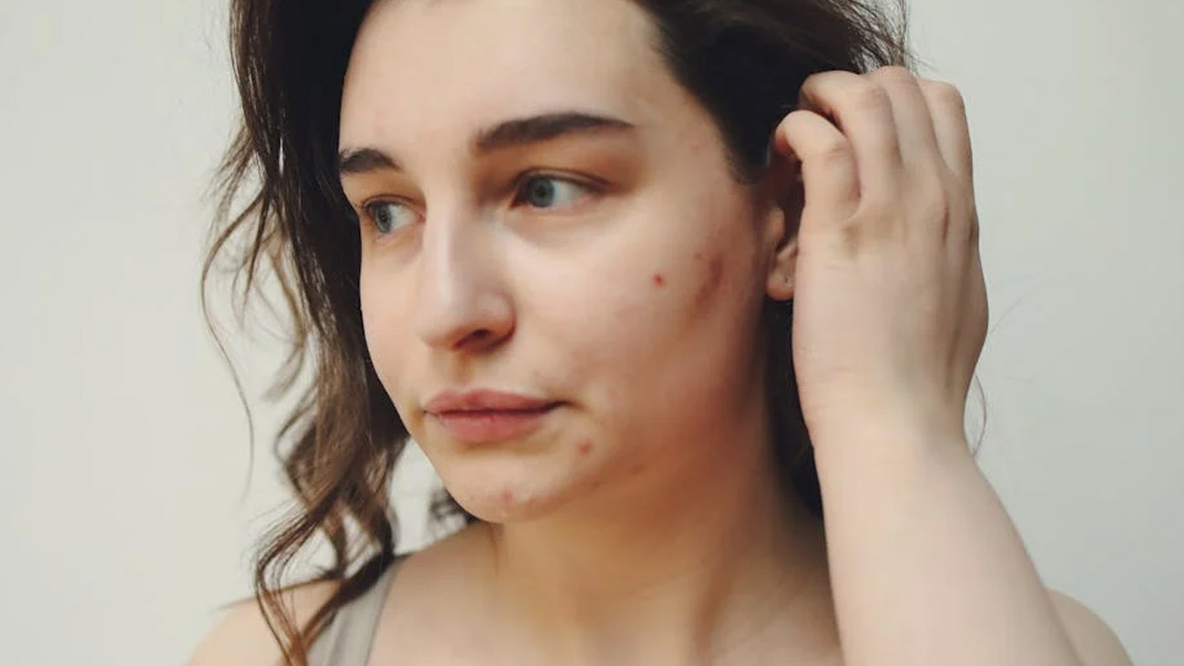 Accutane Pille