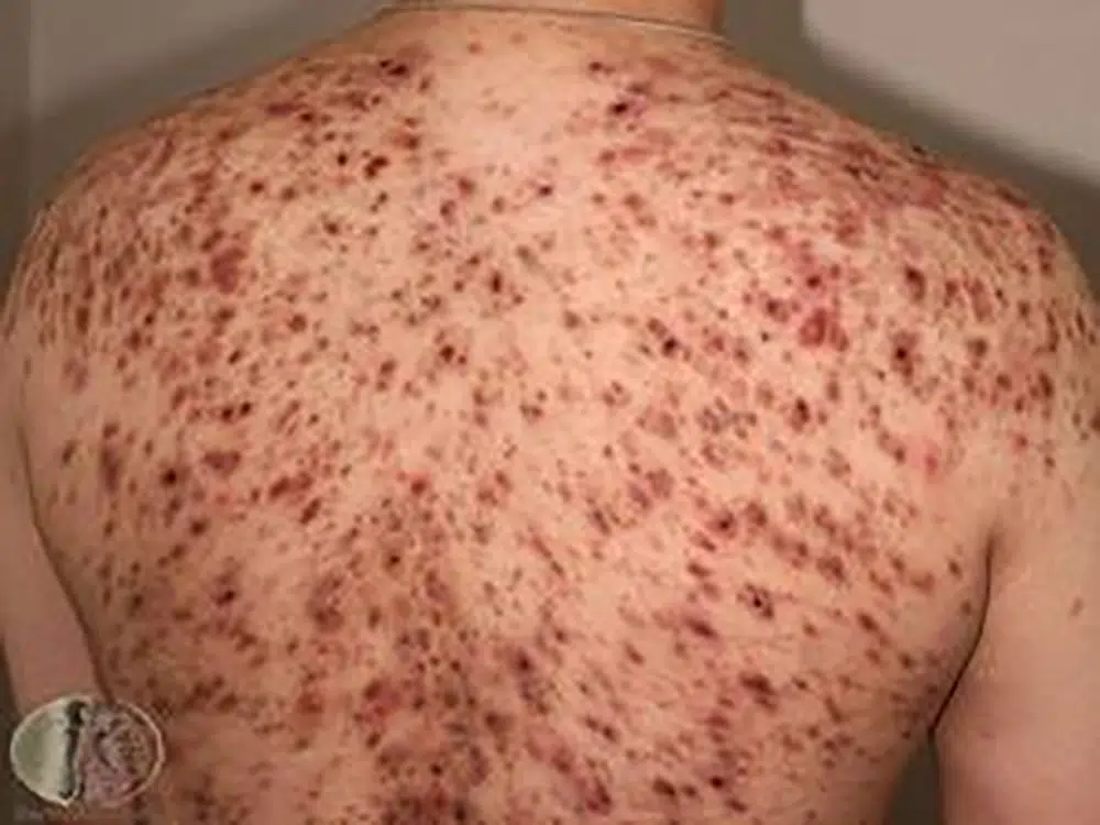 Kaufen Accutane