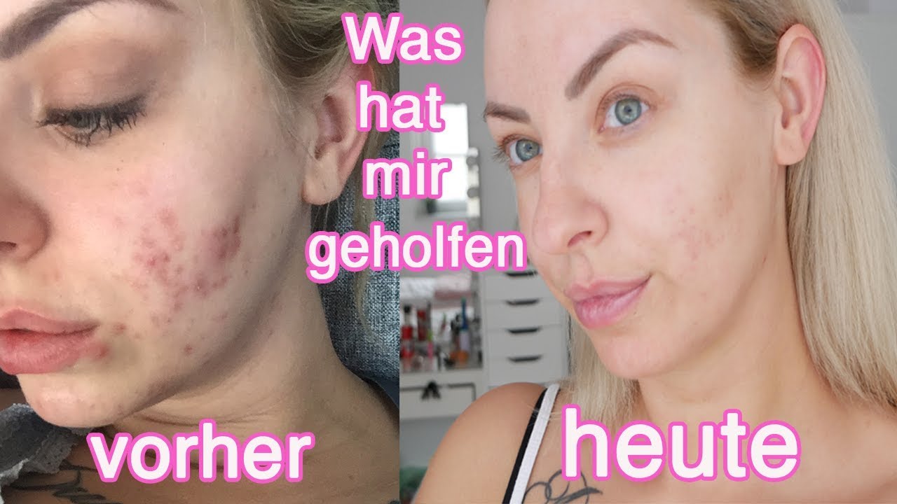Aknenormin generisch kaufen