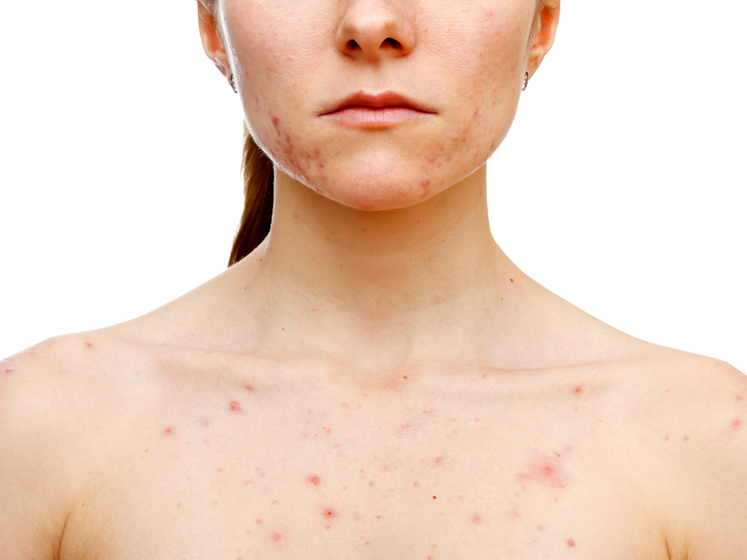 Wo Kann Man Isotretinoin Kaufen