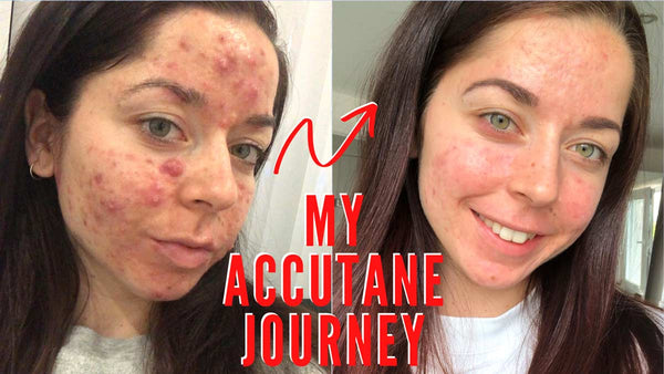 Billigste Accutane