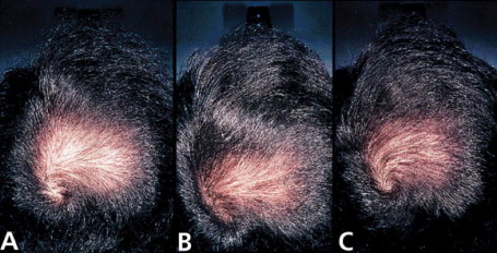 Finasteride kauf
