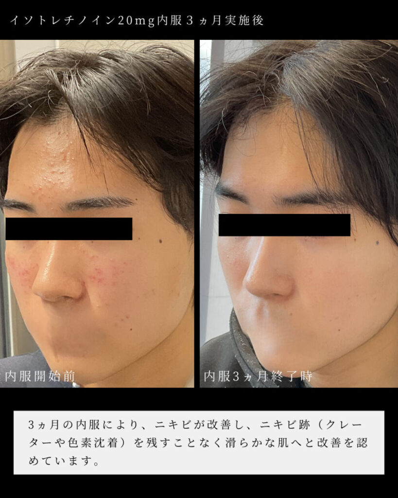 accutane generika