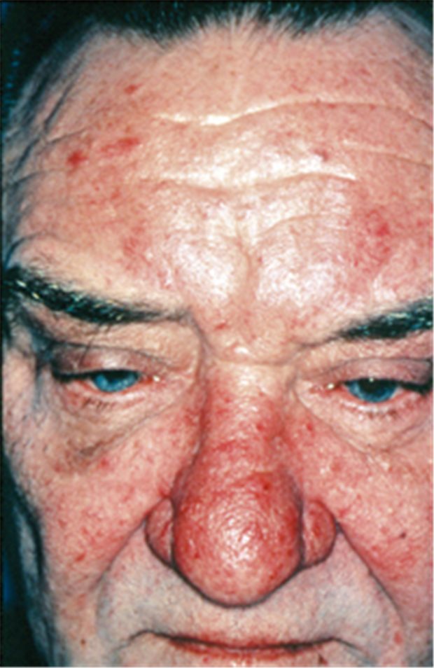 Isotretinoin behandlung kosten