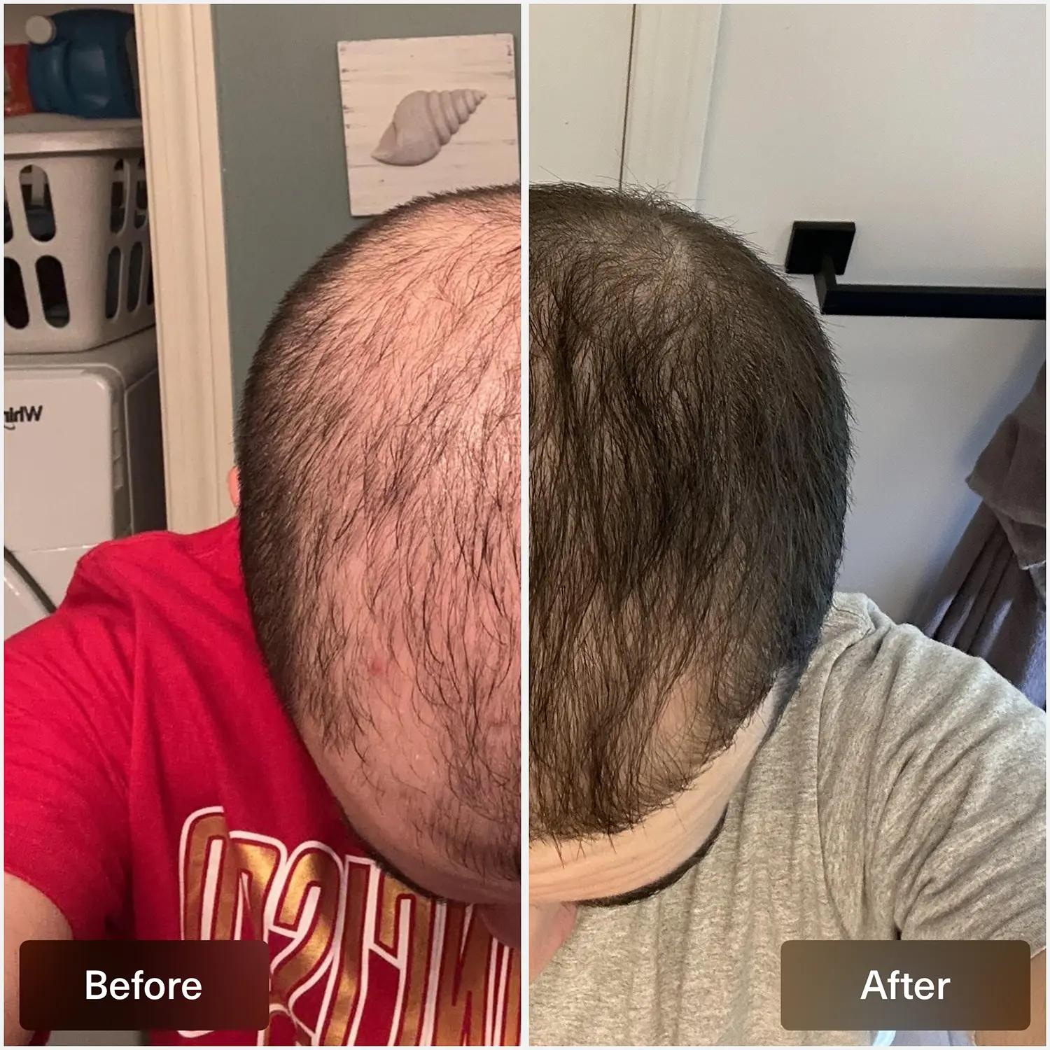 finasteride deutschland kaufen