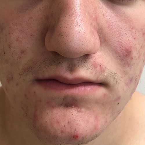 Isotretinoin Akne Kaufen