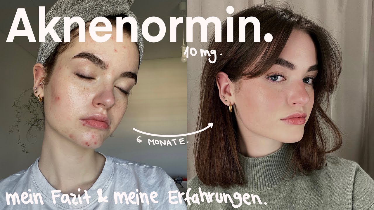 Aknenormin Nach Absetzen Der Pille