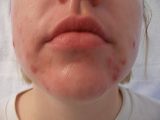 Billiges accutane