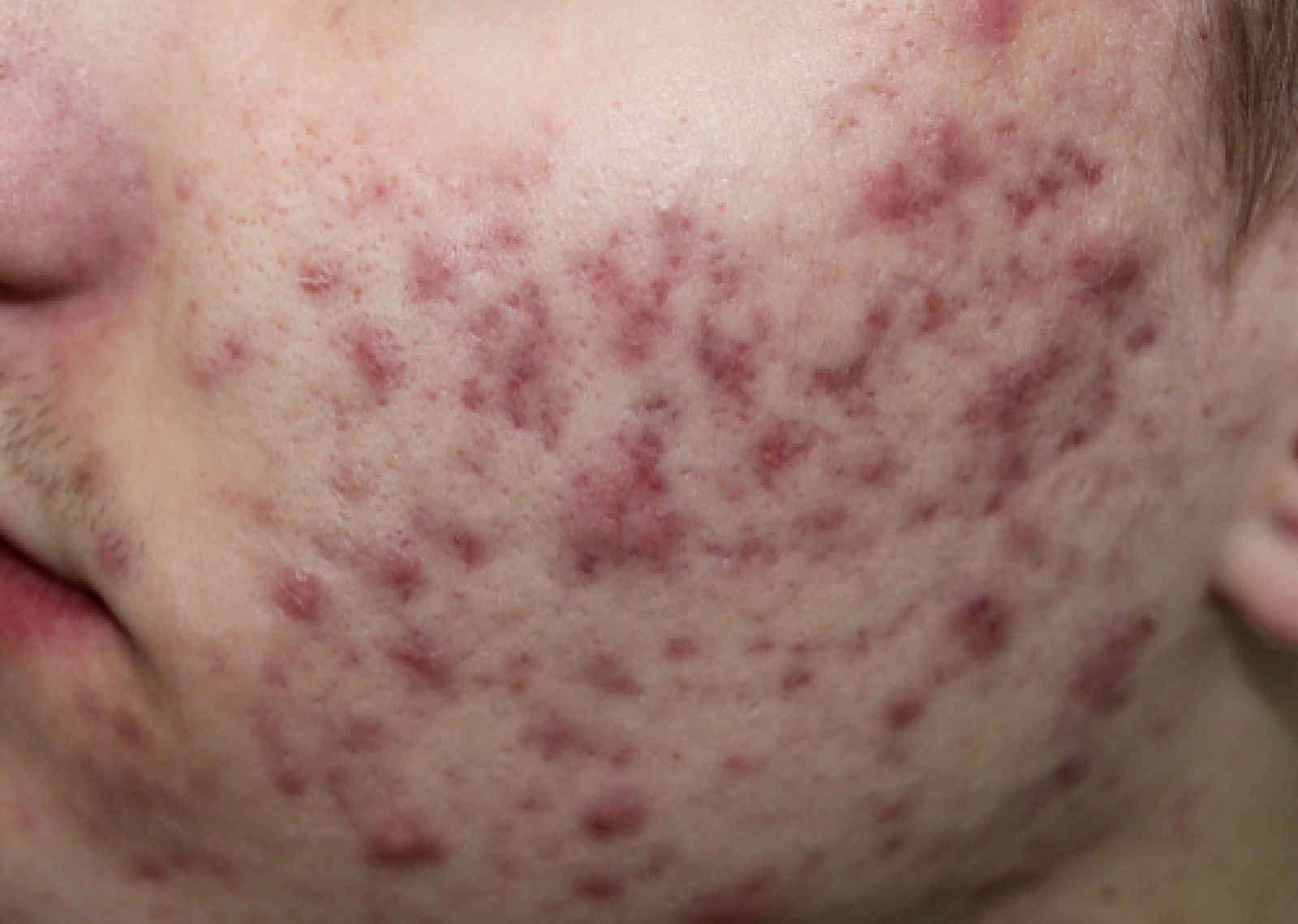 roaccutane kosten