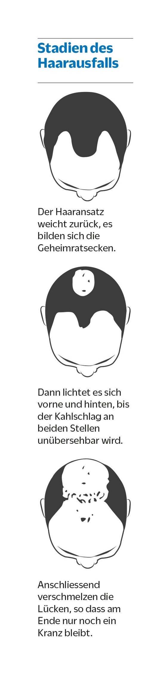 Finasterid Usa Rezeptfrei