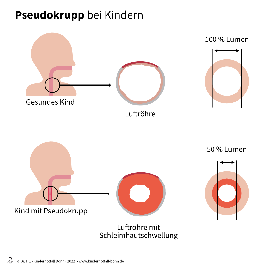 Prednisolon zäpfchen rezeptfrei