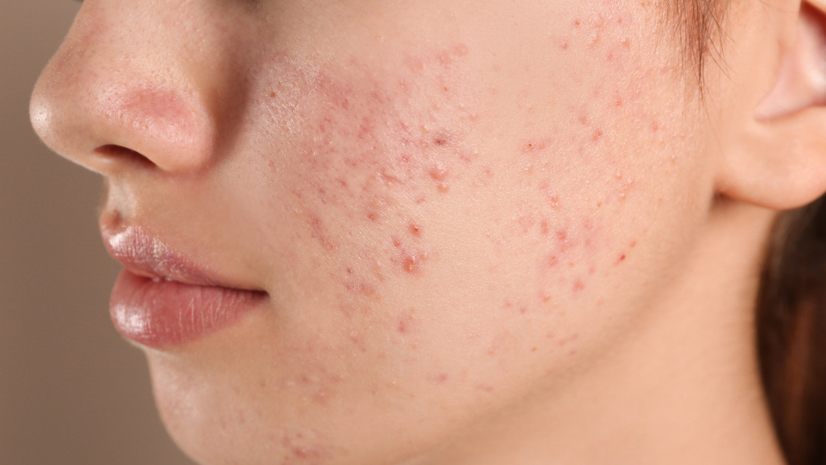 Preis von roaccutane