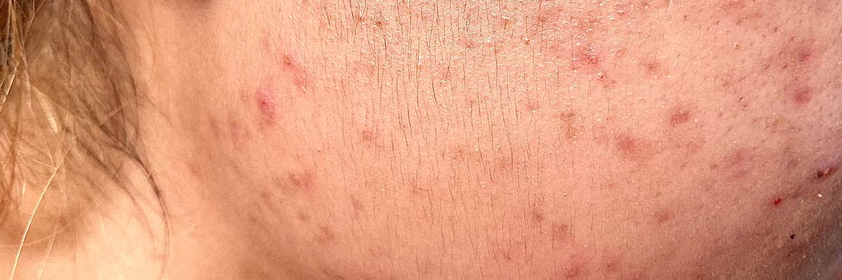 accutane in deutschland