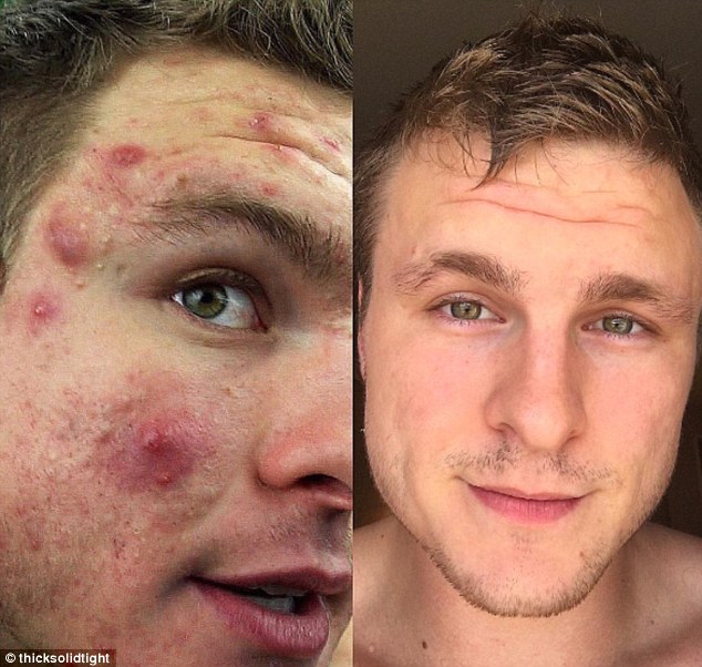 Accutane Online Eu