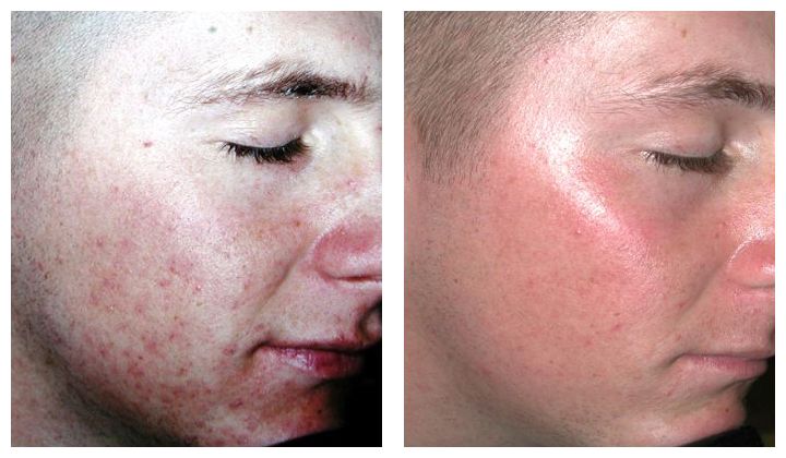 Accutane Online Eu