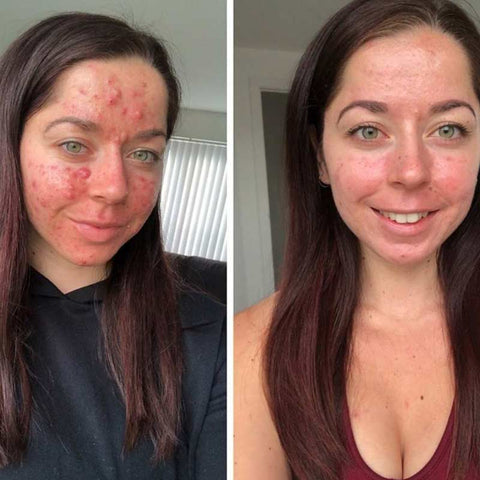 Accutane billigste