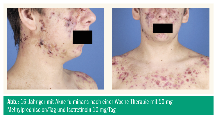 Aknenormin 10mg