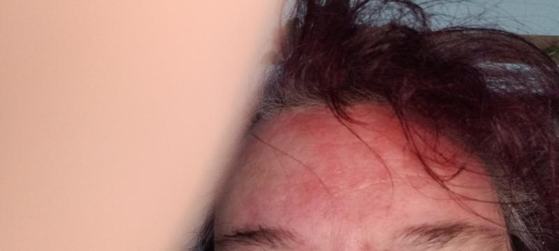 Billig isotretinoin