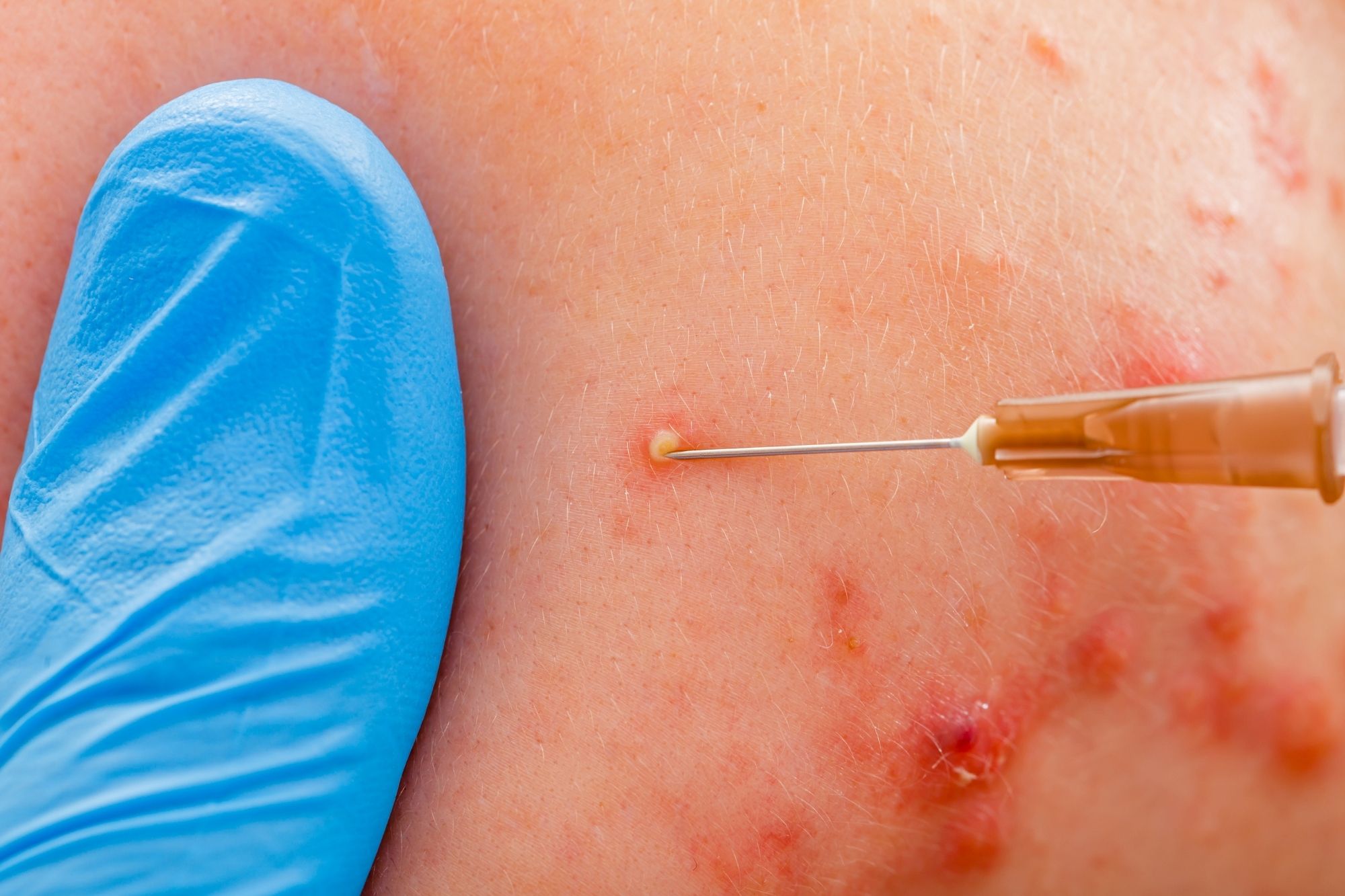billig isotretinoin