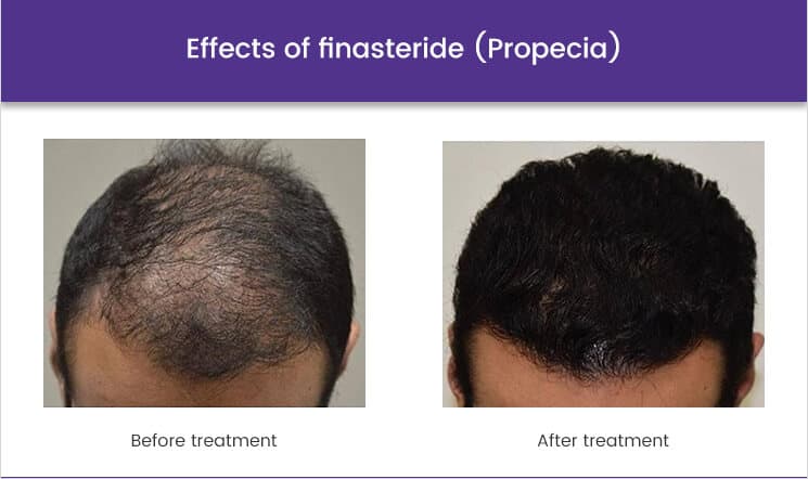 Billigste finasteride