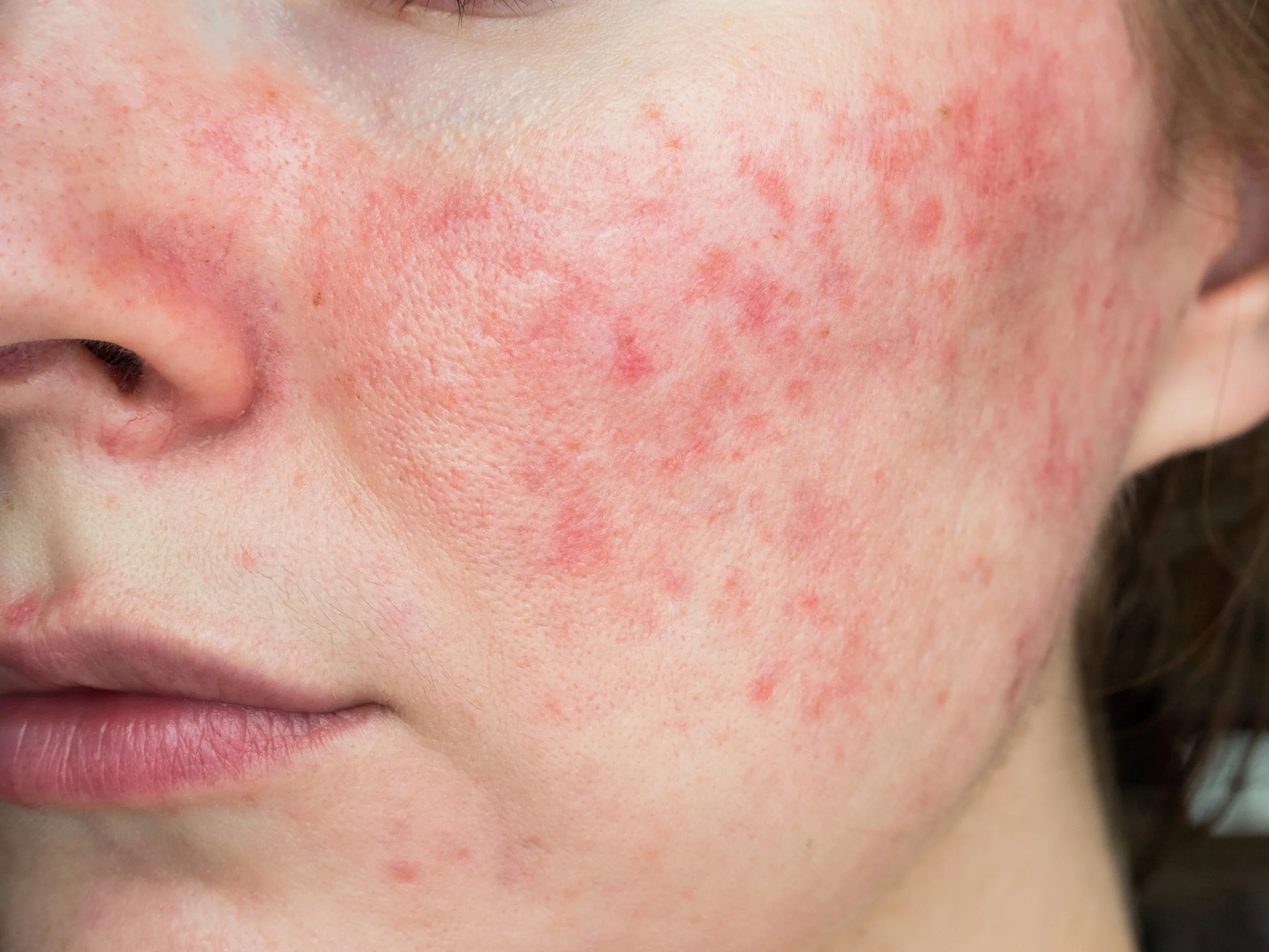 Online rezept isotretinoin