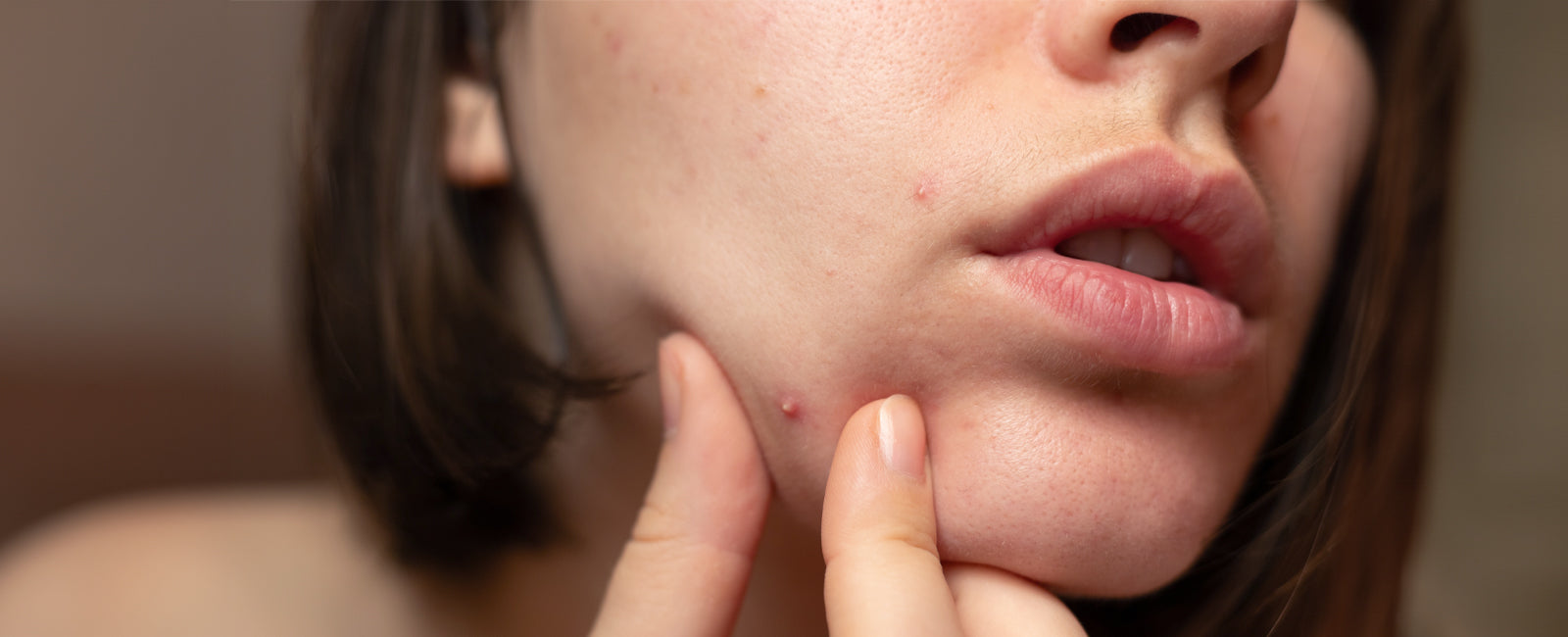 Isotretinoin deutschland