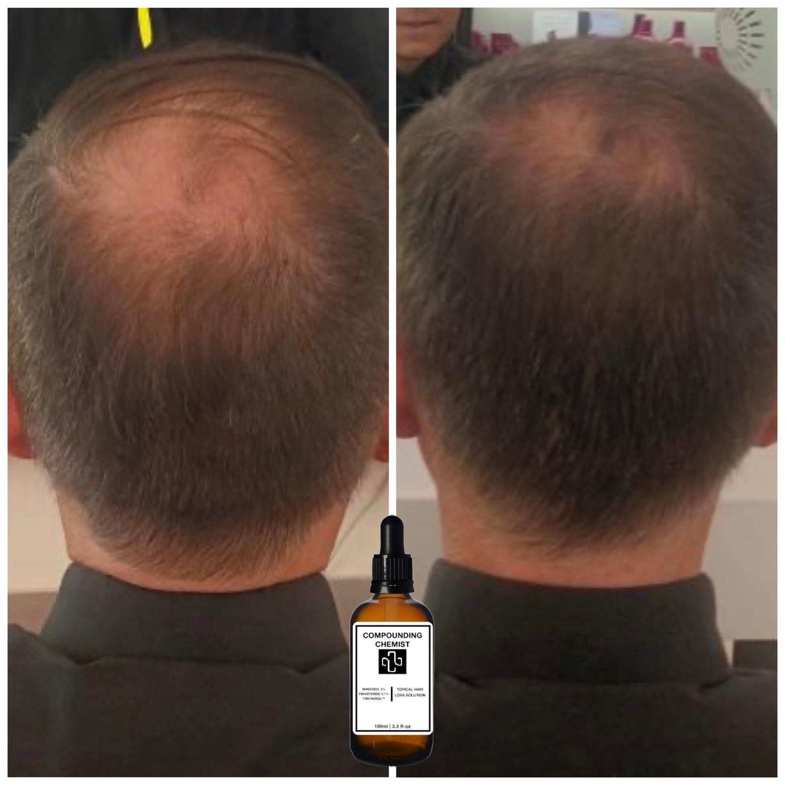 Kosten finasteride apotheek