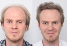 Finpecia Generische Bestellen