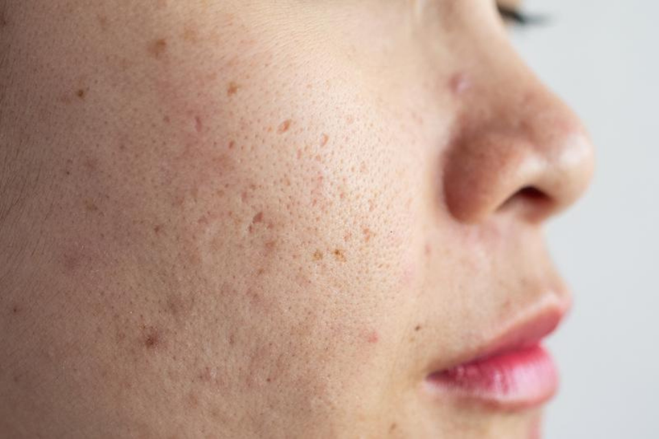 isotretinoin generisch kaufen