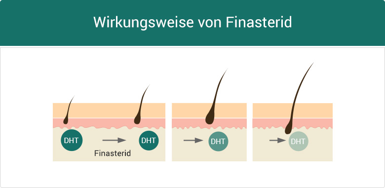 Finasterid Kosten Pro Monat