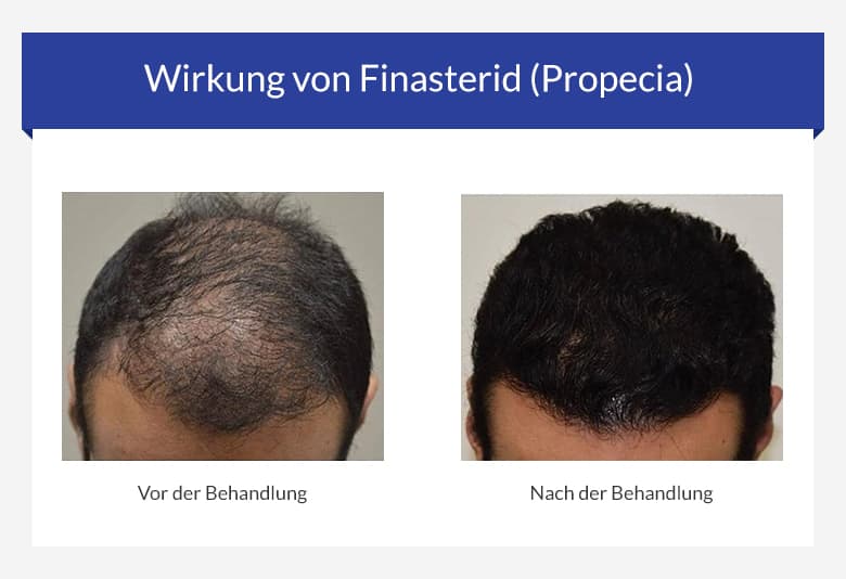 finasterid rezeptfrei bestellen