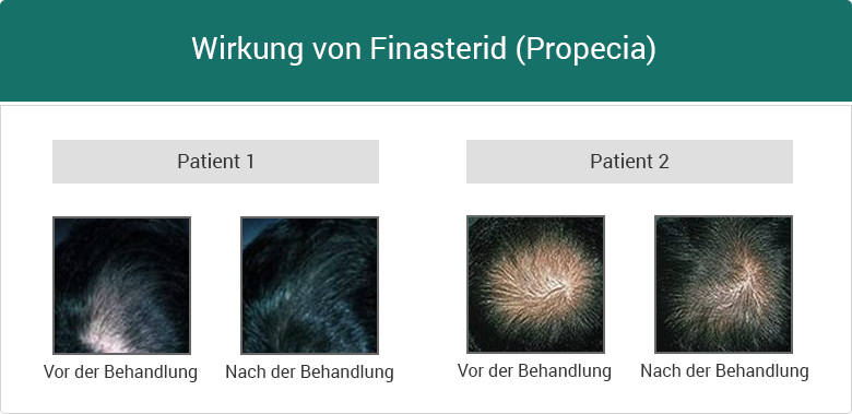 Finasteride Rezeptfrei